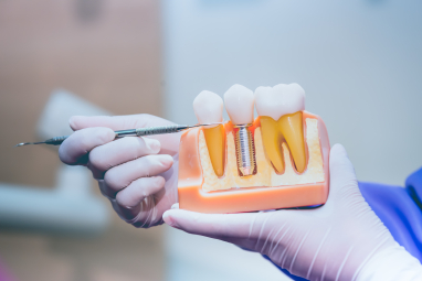 Implante Dentário