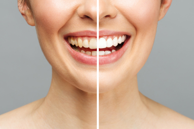 Clareamento Dentário