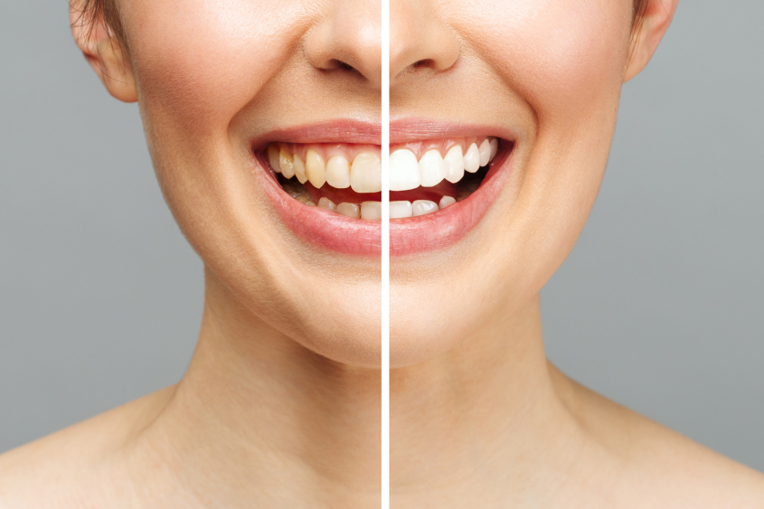 Clareamento Dentário